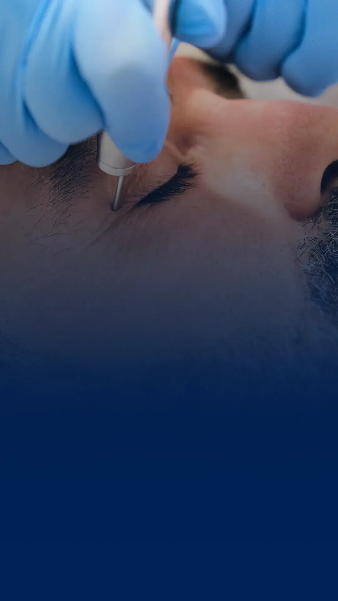 Banner blefaroplastia com laser uai