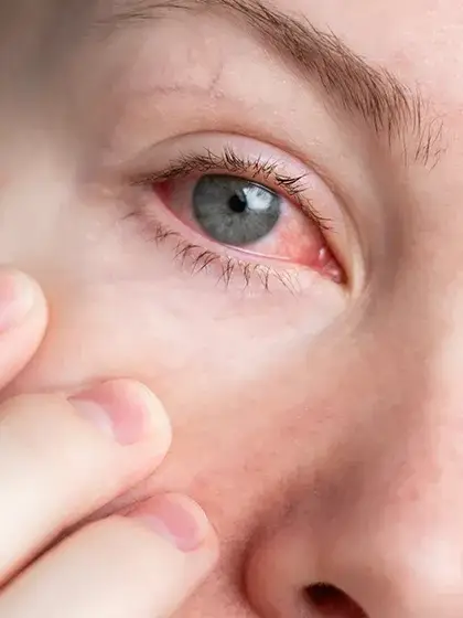 Glaucoma olhos vermelhos uai