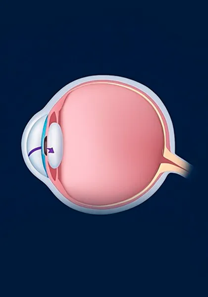 Glaucoma aberto