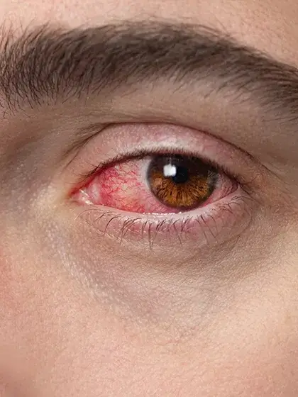 Neurites Opticas uai