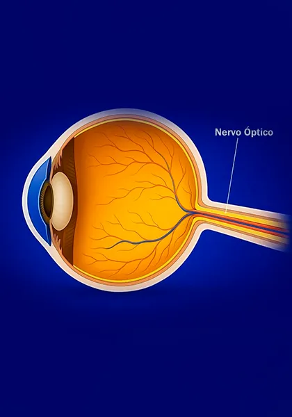 Neuropatias Opticas