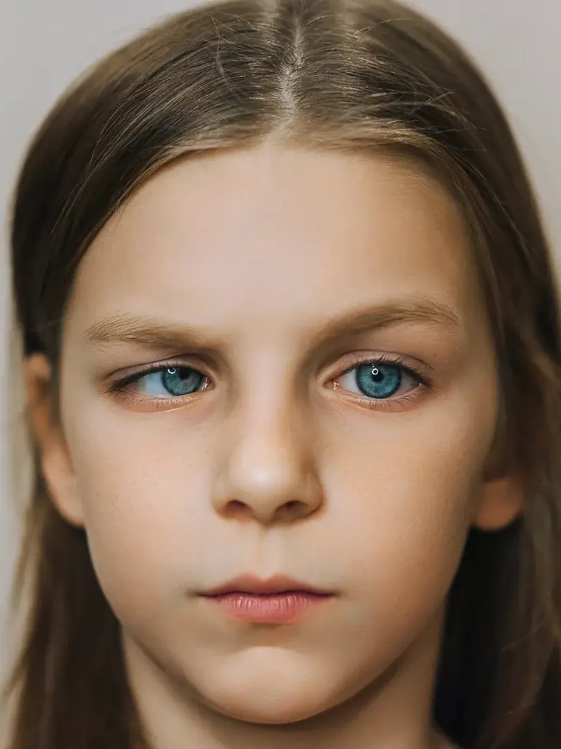 O que e estrabismo uai