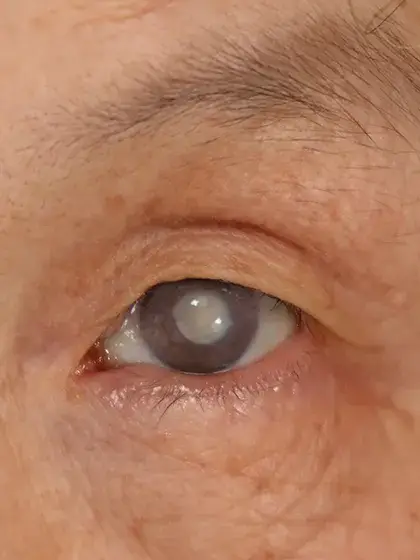 Oftalmologia geral catarata uai