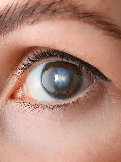 Oftalmologia Pediatrica Catarata Congenita uai