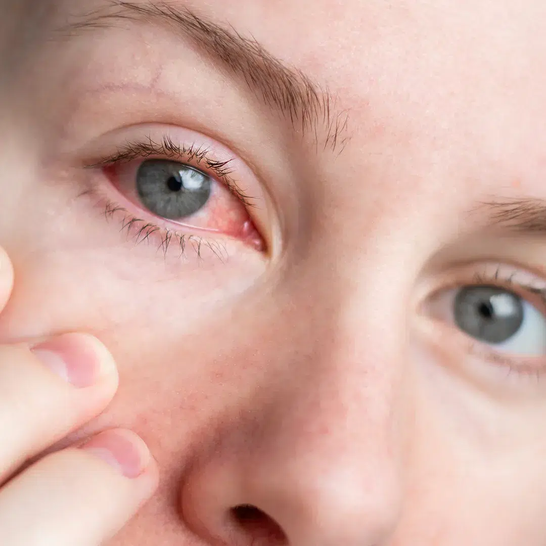 02 Cirurgia d glaucoma