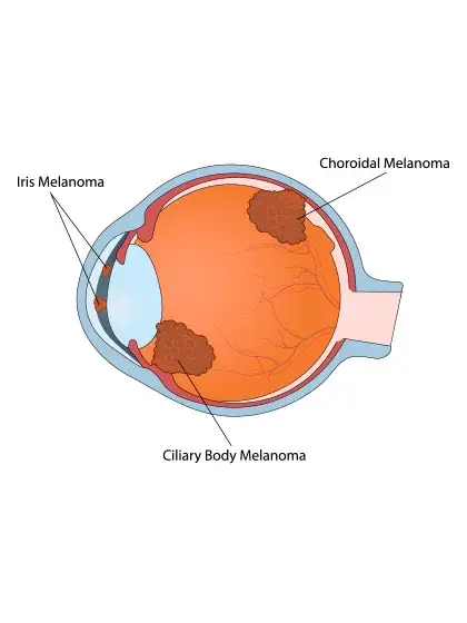 02 Melanoma Uveal uai