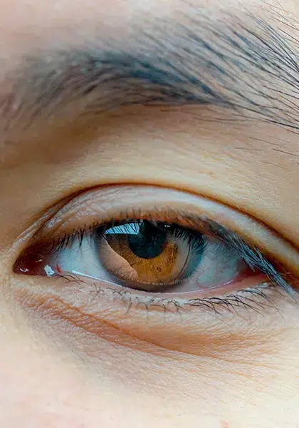 02 Plastica e Vias Lacrimais Ptose Palpebral