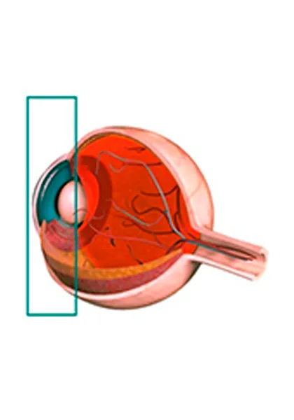 02 Uveite Anterior