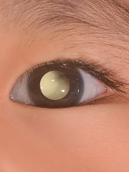 03 Oncologia Ocular Retinoblastoma uai