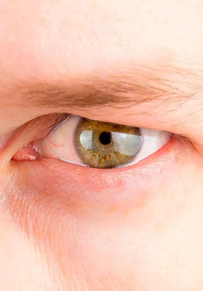 03 Plastica e Vias Lacrimais Dermatocalase