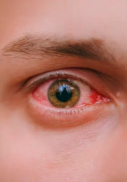 03 RETINA E ViTREO Retinopatia Diabetica