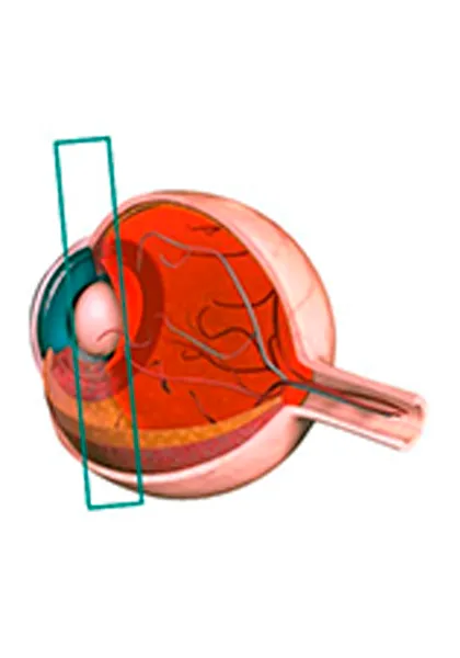 03 Uveite Intermediarial