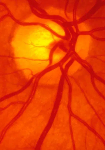 03 Visao Subnormal Doencas Degenerativas da Retina