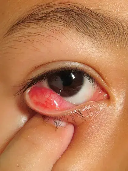 04 Oncologia Ocular Linfoma Ocular uai