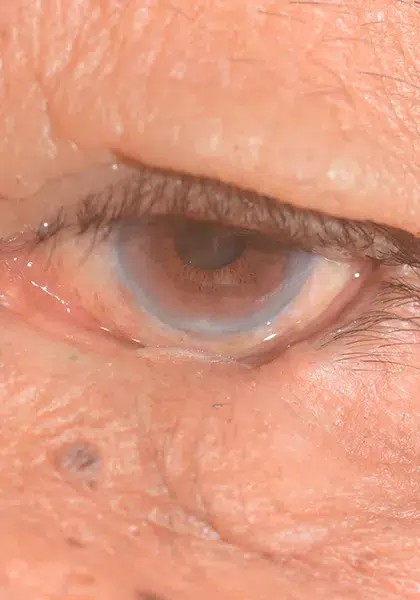 04 Plastica e Vias Lacrimais Entropio