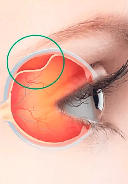 04 RETINA E ViTREO Descolamento de Retina