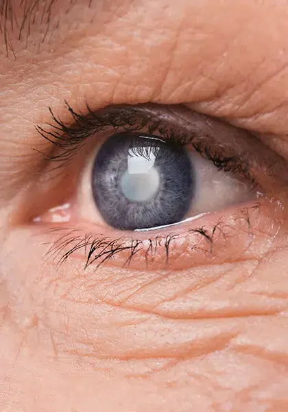 04 Visao Subnormal Glaucoma