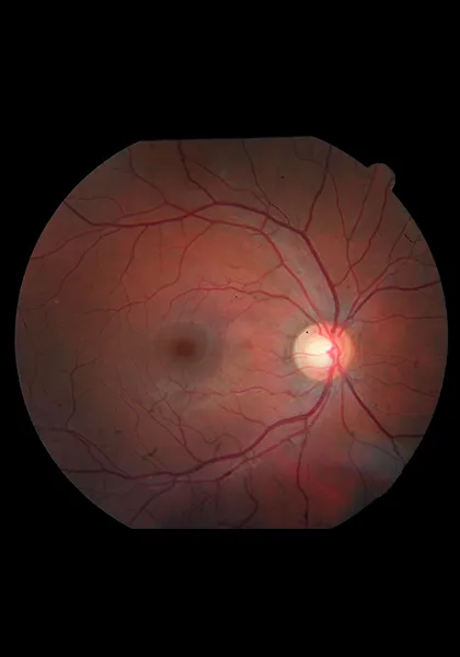 04 Exames Angiografia Fluoresceinica