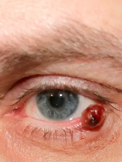 05 Oncologia Ocular Tumores de Conjuntiva e Palpebras uai