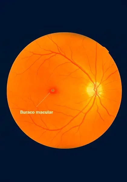 05 RETINA E ViTREO Buraco Maculara