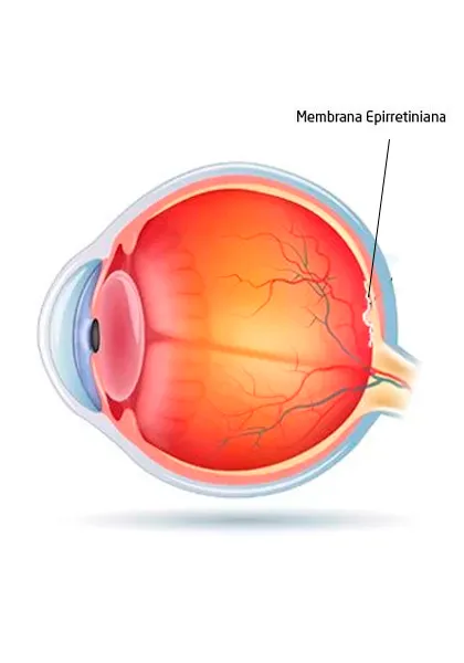 05 RETINA E ViTREO Membrana Epirretiniana