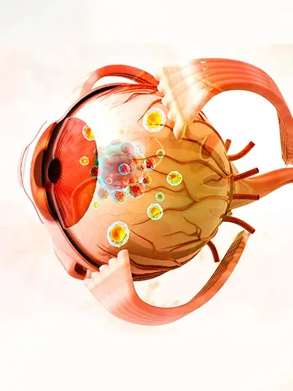 06 Oncologia Ocular Metastases Oculares uai