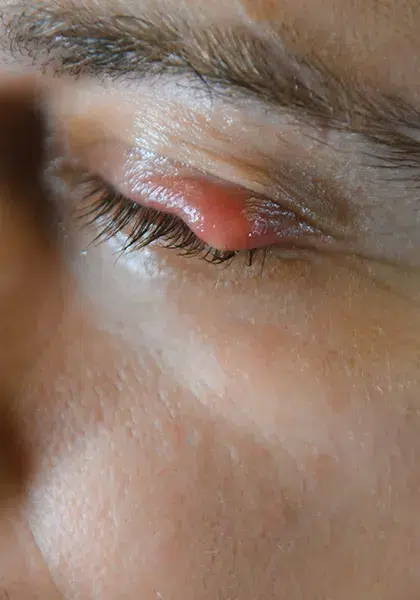 06 Plastica e Vias Lacrimais Tumores Palpebrais