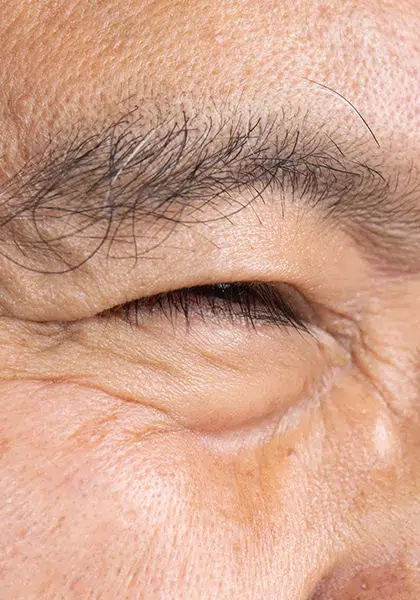 07 Plastica e Vias Lacrimais Blefaroespasmo