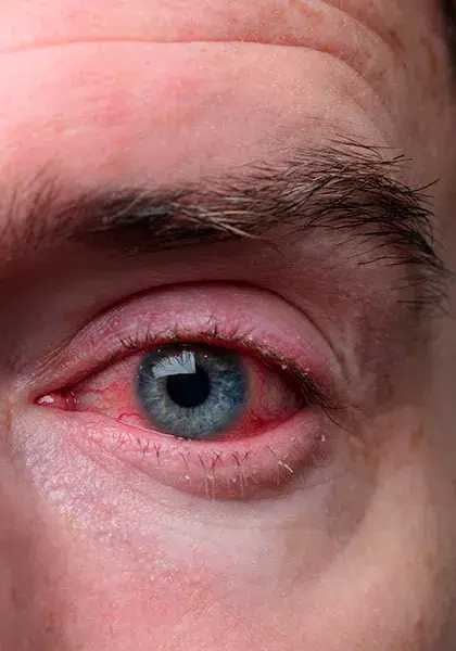 07 emergencia Presenca de corpos estranhos nos olhos