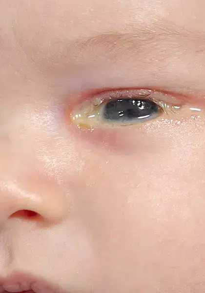 08 Plastica e Vias Lacrimais Obstrucao e Infeccao das Vias Lacrimais