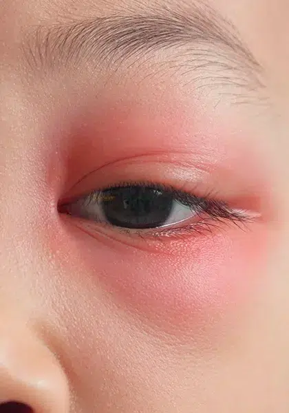 08 emergencia Sintomas de infeccao ocular grave