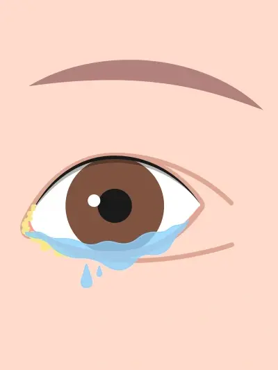 Obstrucao das vias lacrimais uai