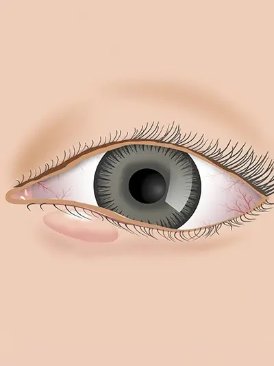 Tumores Palpebrais uai